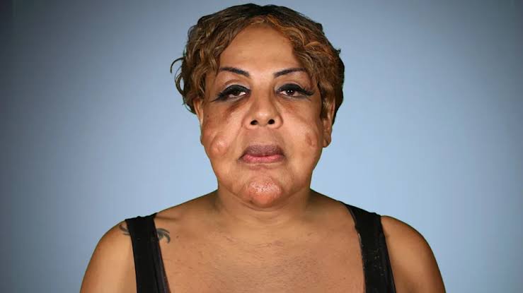 Woman With Cement in Her Face Gets Help From Plastic Surgeons