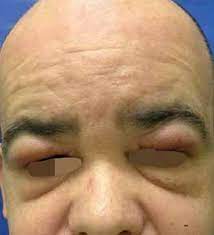 Morbihan's disease is classically defined as primarily a caucasian disease of chronic, recurrent erythema and nonpitting edema of the middle and upper thirds of the face. Scielo Brasil Morbihan Syndrome A Case Report And Literature Review Morbihan Syndrome A Case Report And Literature Review