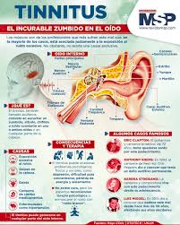 InfografíaMSP | El zumbido en los oídos puede originarse por diversas  razones que no siempre están relacionadas con una enfermedad. La exposición  a sonidos altos, acumulación de cera, efectos secundarios de medicamentos