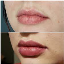 1 syringe of juvederm ultra. Dermal Filler Before And Afters In Denver Co The Luxe Room