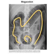 Image result for Megacolon
