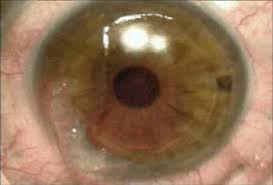 Haze) 8 Months After Prk And Cxl : R/Keratoconus