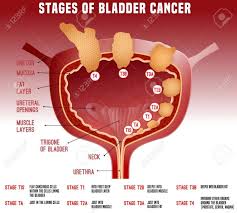 Image result for Bladder Cancer