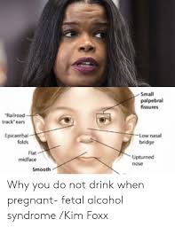 A fold of skin that comes down across the inner angle of the eye. Small Palpebral Fissures Railroad Track Ears Epicanthal Folds Low Nasal Bridge Flat Midface Upturned Nose Smooth Why You Do Not Drink When Pregnant Fetal Alcohol Syndrome Kim Foxx Pregnant Meme On