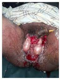 We did not find results for: Fournier S Gangrene Current Practices