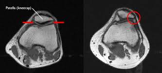 Both the pronounced accuracy of the mri and the high prevalence of knee disorders, makes the knee mri the most frequently ordered imaging procedure of the musculoskeletal system. Patellofemoral Pain Syndrome Orthoinfo Aaos