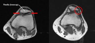 Atlas of knee mri anatomy this webpage presents the anatomical structures found on knee mri. Patellofemoral Pain Syndrome Orthoinfo Aaos