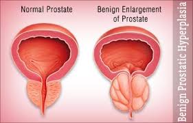 Benign Prostatic Hyperplasia Bph Penyebab Gejala Dan Penanganan Idn Medis