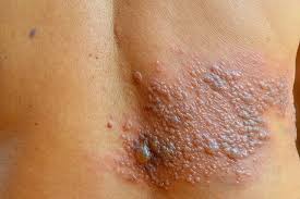 Dermatite Herpetiforme O Que E Sintomas E Tratamento Tua Saude