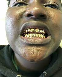 Speak with a general dentist or prosthodontist to dis. Gold Teeth Grills 6 Top Or Bottom 10k Permanent Style Grills Ebay
