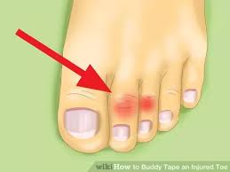 One way to know whether your toe is broken is if you can put weight on the foot. How To Buddy Tape An Injured Toe Broken Toe Toe Injuries Toes