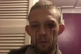 Gainsborough man's warning after being 'glassed out of nowhere'