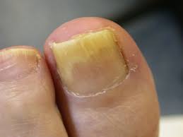 Image result for onychomycosis