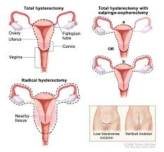 Doctors usually categorize a case as stage 1 ovarian cancer when the cancerous cells have not spread to other areas of the body. How We Treat Ovarian Cancer Dana Farber Cancer Institute Boston Ma