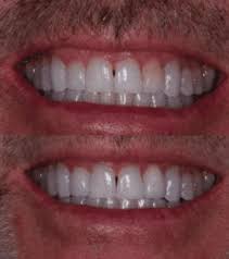 Image result for Tooth Discoloration