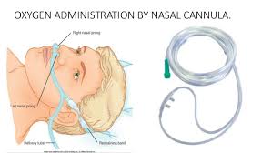 Using a nasal cannula means you'll have increased oxygen levels, and hopefully increased energy and reduced fatigue, as you'll be able to breathe easier during the day and sleep better at night. Oxygen Administration
