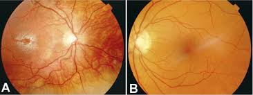 Patients With Sjogren Larsson Syndrome Lack Macular Pigment Ophthalmology