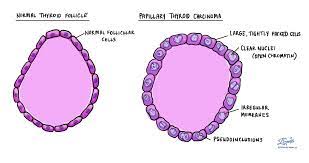 Papillary thyroid carcinoma is given a tumour stage between 1 and 4 based on the size of the tumour and the presence of tumour cells outside of the thyroid (see extrathyroidal extension above). Papillary Thyroid Carcinoma Mypathologyreport Ca