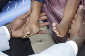 Clubfoot translated between english and german including synonyms, definitions, and related words. Somali Ponseti Clubfoot Care Organization Sopcco Twitter