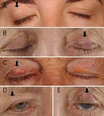 Below are 47 working coupons for eyelid gold weight cpt code from reliable websites that we have updated for users to get maximum savings. Indications And Outcomes For Revision Of Gold Weight Implants In Upper Eyelid Loading British Journal Of Ophthalmology