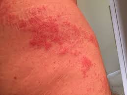 Shingle S Rash Back Pain And Skin Sensitivity