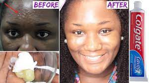 Check spelling or type a new query. I Applied Toothpaste And Vaseline On My Face And See What Happened The Next Day Youtube