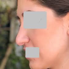 LARRY S NICHTER, MD MS ,FACS