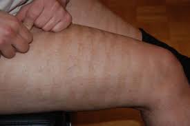 This is one of the best home laser hair removal machines at the lower. Bellalite By Silk N Professional Hair Removal At Home Review Laser Hair Removal Guide