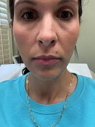 Agnes eye treatment #2 today. Takes about 2 months to fully heal This  treatment is microneedling with radio frequency to burn away these  hereditary fat bags. Don't tell me I didn't need