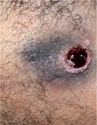 This paper describes various aspects of gunshot wounds, including entrance and exit patterns, angle and path, range of fire and velocity, and caliber of the bullet, based on observations of a series of known cases. Pathology Outlines Gunshot Wounds