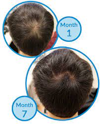 Hair thinning around crown or vertex is one of the few notable symptoms of androgenic alopecia, commonly known as male pattern baldness. Is My Double Crown A Sign Of Male Pattern Hair Loss