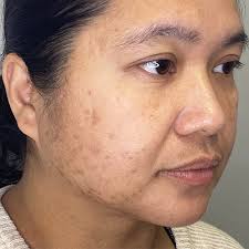 Clear Skin with AC Dual IPL Acne Treatment: Olive Tree Aesthetics