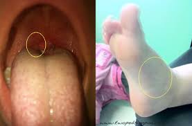 Image result for Hand foot and mouth disease HFMD roof of mouth