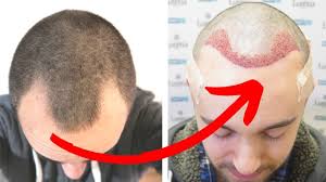 Direct Hair Implantation (DHI) surgery
