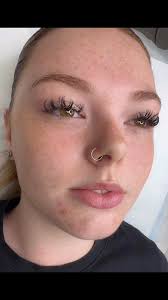 ✨ Perfect Lip filler 👄 Balance with Hyaluronic Acid ✨🥰My client already  had naturally beautiful lips, but she wanted something very specific: to  balance the volume between her top and bottom lip. 💉👌🏼I ...