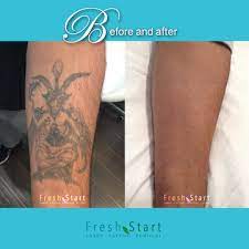 With prices as low as $99, the only thing you have to lose…. Tattoo Removal Austin Tx Fresh Start Laser Tattoo Removal