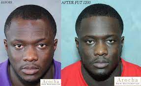 Men's african american hair transplant dr. Ethnic Hair Restoration Treatment In Texas
