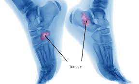 Symptoms of a bone tumor in your foot. Fighting Bone Cancer Symptoms Diagnosis Treatments