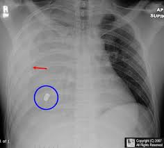 Learning Radiology Hemothorax