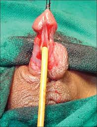 Résultat de recherche d'images pour "penis degloved"