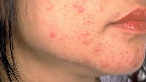Heat ruins your skin and blocks elimination of toxins. Is That Rash Psoriasis Psoriasis Pictures And More Everyday Health