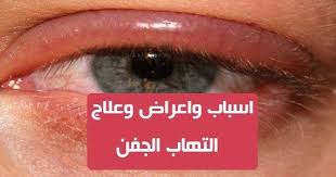 التهاب الجفن هو مرض يتكون من التهاب الجفن من المهم التعامل معه بشكل صحيح لتجنب المضاعفات التهاب الجفن هو التهاب لحافة الجفن لفهم هذه الحالة من المهم أن تتذكر