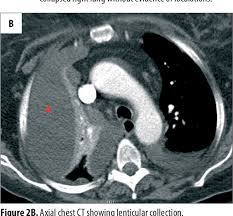 We did not find results for: Figure 2 From Multiloculated Pleural Effusion Detected By Ultrasound Only In A Critically Ill Patient Semantic Scholar