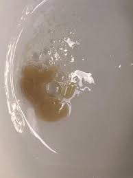 Image result for Sputum