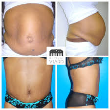 Le prix de la chirurgie du ventre dépend de la complexité de. Abdominoplastie Chirurgie De La Silhouette A Lyon Dr Viard