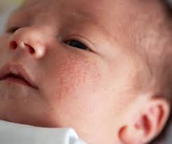 Image result for sweat rash on back baby