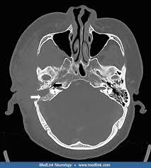 Image result for Otalgia