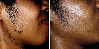 Laser hair removal has become very effective in the past ten years. Laser Hair Removal For Asian And Dark Skin Good Skin Days Leeds