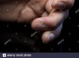 Nagelbettentzundung Stockfotos Und Bilder Kaufen Alamy