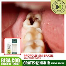 Maybe you would like to learn more about one of these? Obat Gigi Bolong Gigi Keropos Gigi Ngilu Anak Dan Dewasa Herbal Propolis Sm Shopee Indonesia